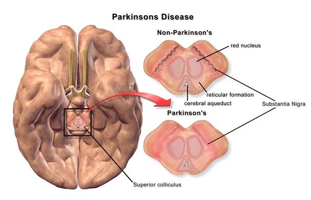 Vrijwilligers voor Parkinsonhuys gezocht
